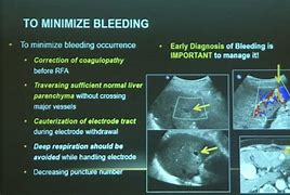 Image result for Microwave Ablation Liver