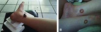 Image result for Moxibustion Burns