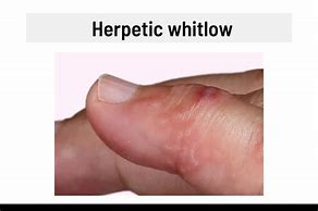 Image result for Blister Wart On Finger
