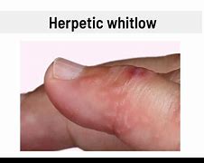 Image result for Herpetic Whitlow On Finger