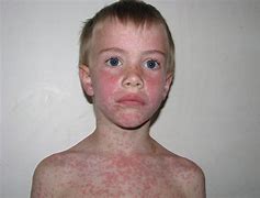 Image result for Azithromycin Allergic Reaction