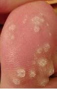 Image result for Viral Wart On Finger