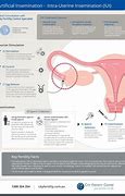 Image result for Artificial insemination