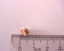 Image result for Picture of 5Mm Kidney Stone