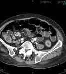 Image result for Ileum Carcinoid Tumor