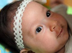 Image result for Spinobifida Baby