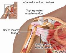 Image result for Inflamed Shoulder Tendons
