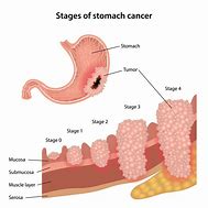 Image result for Stomach Cancer
