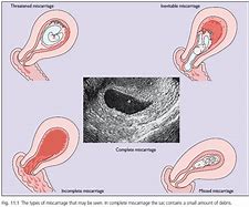 Image result for What Do Early Miscarriages Look Like