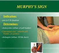 Image result for McBurney and Murphy's Sign