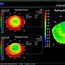Image result for Corneal Topography After Lasik