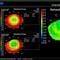 Image result for Eye Topography Before and After Lasik