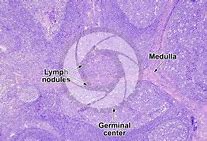 Image result for adenoloy�a