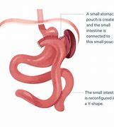 Image result for Brain Tumor and Gastric Bypass Surgery