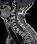 Image result for Cervical Spine MRI T1