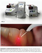 Image result for diodes lasers treatment