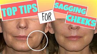 Image result for Sagging Cheeks Treatment