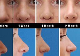 Image result for Nose Tip Swelling After Rhinoplasty