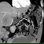 Image result for Gist Tumor of Small Bowel On CT