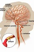 Image result for Carotid vs Vertebral Artery