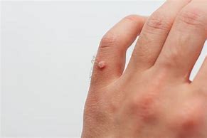 Image result for Multiple Warts On Hand