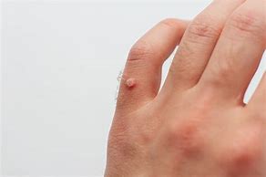 Image result for Large Wart On Finger