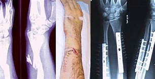 Image result for Broken Arm Bone Sticking Out