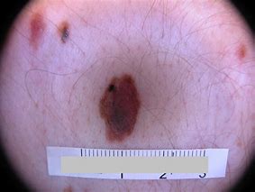 Image result for Melanoma Skin Cancer Removal