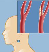 Image result for Carotid Artery Plaque