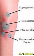 Image result for Inflamed Bursa Knee