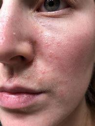 Image result for Allergy Bumps
