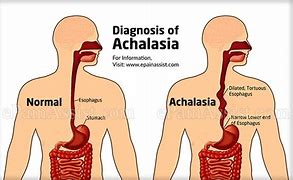 Image result for acolasa