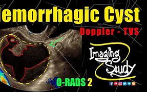 Image result for Hemorrhagic Ovarian Cyst On Ultrasound