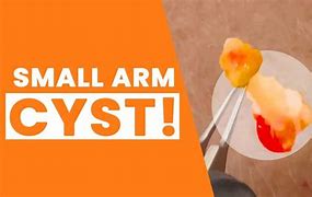 Image result for 16Cm Cyst