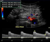 Image result for Renal Artery Stenosis Ultrasound
