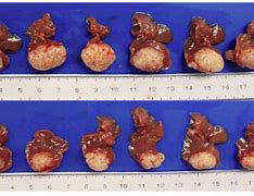 Image result for How Big Is 8Mm Tumor