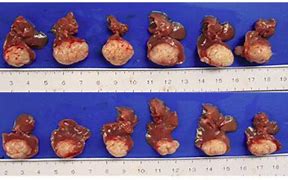 Image result for How Big Is 8Mm Tumor