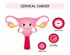 Image result for Cervical Cancer Cartoon