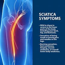 Image result for Sciatica Pain Pattern
