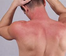 Image result for SunBurn Symptoms