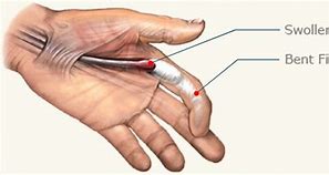 Image result for Trigger Finger Medscape