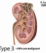 Image result for Simple Renal Cyst Ultrasound