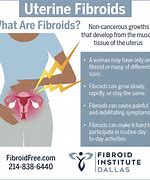 Image result for Symptoms of a Uterine Fibroid
