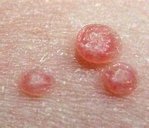 Image result for Molluscum Warts On Back of Knee