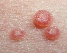 Image result for Molluscum On Knee