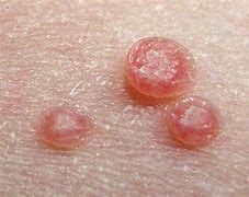Image result for Maluscum Wart