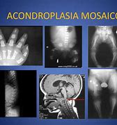 Image result for acpndroplasia