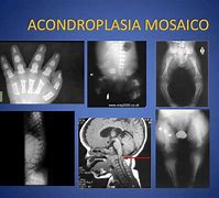 Image result for aconfroplasia