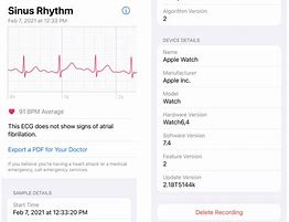 Image result for Lbbb Apple Watch ECG