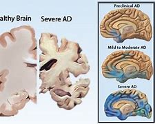 Image result for Normal Shrinking of the Brain